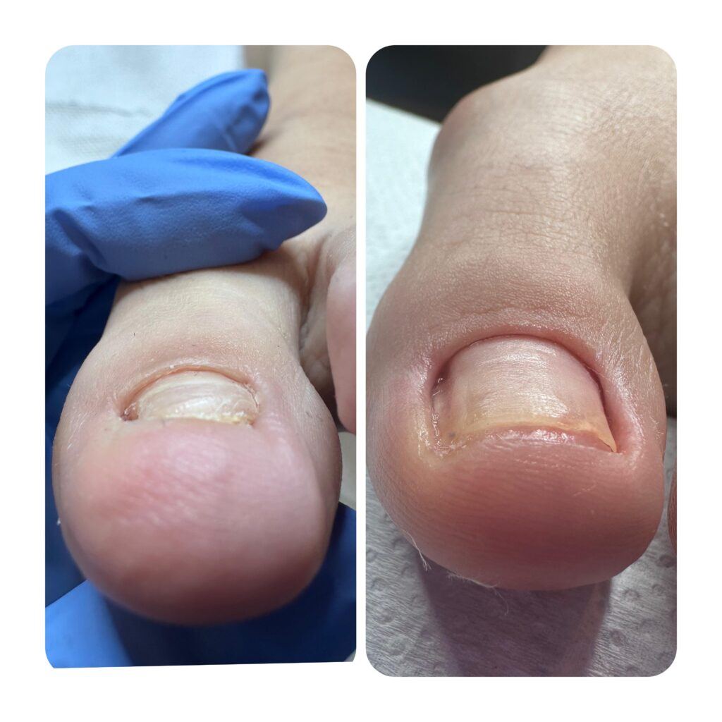 Înainte & după, Podo Step By Step