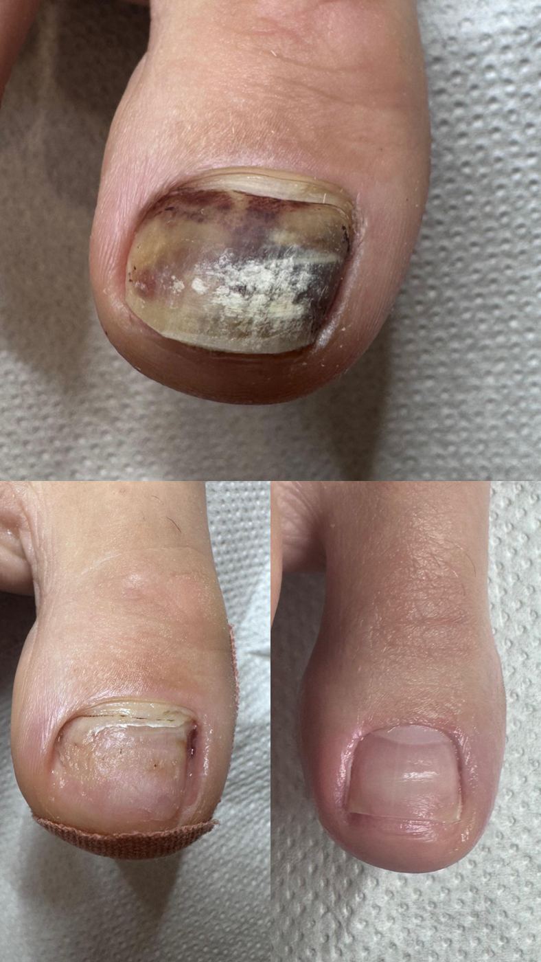 Înainte & după, Podo Step By Step